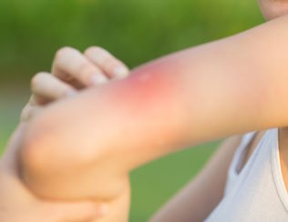 Insektenstich auf Arm-Parapic